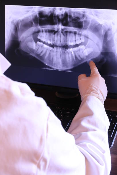 Best Emergency Wisdom Tooth Extraction in Laguna Vista, TX